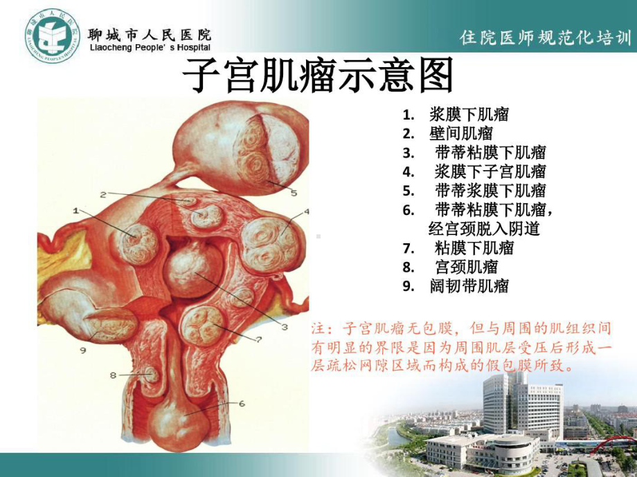 子宫肌瘤的超声诊断与鉴别共31张课件.ppt_第3页