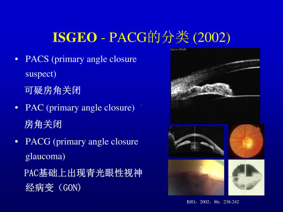 原发闭角青光眼诊疗规范20张课件.ppt_第3页