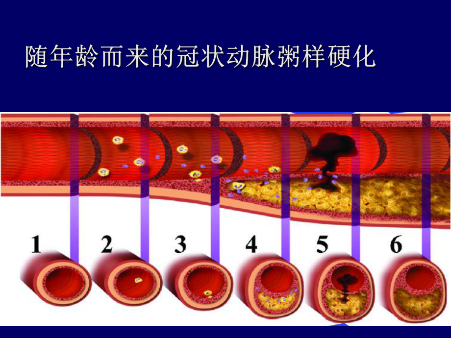 冠心病的抗血小板治疗(拜阿斯匹灵I级预防)课件.ppt_第2页