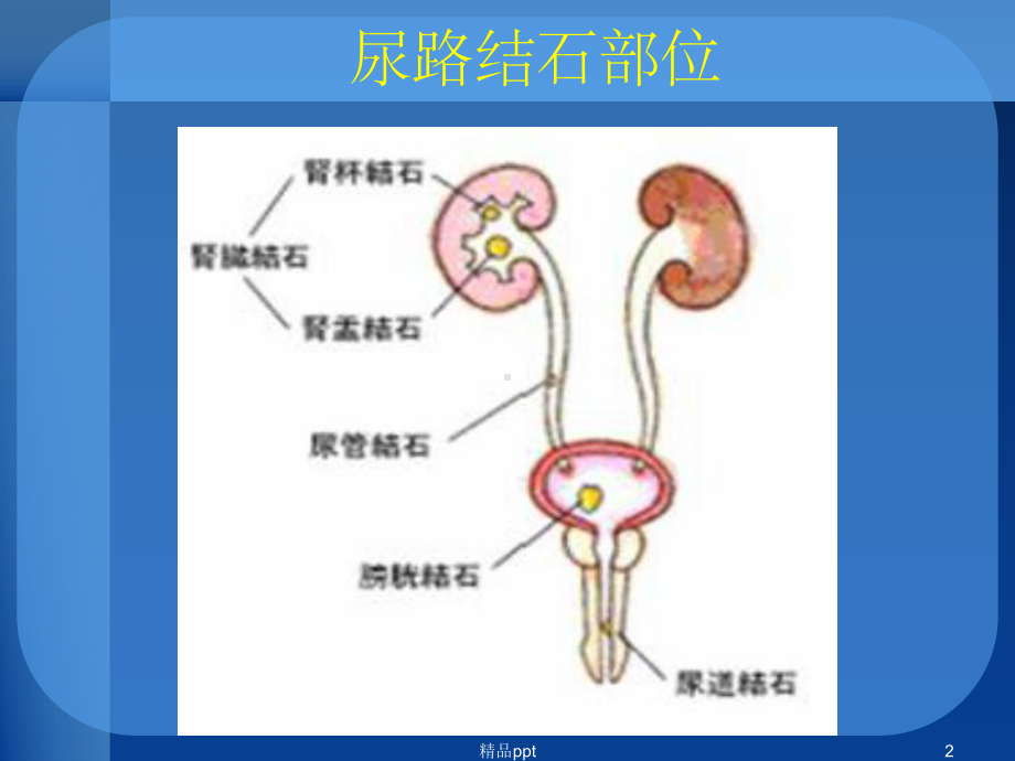 尿路结石的现代综合治疗课件.ppt_第2页