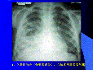 化脓性肺炎(金葡菌感染)右肺多发脓腔及气囊课件.ppt