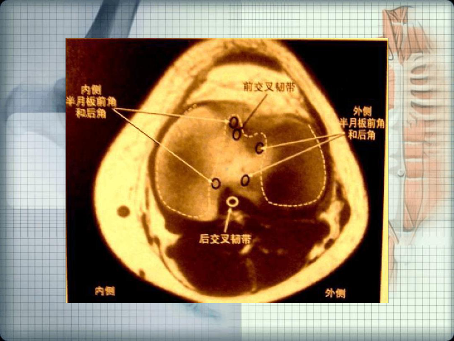 半月板损伤的磁共振表现课件.ppt_第3页