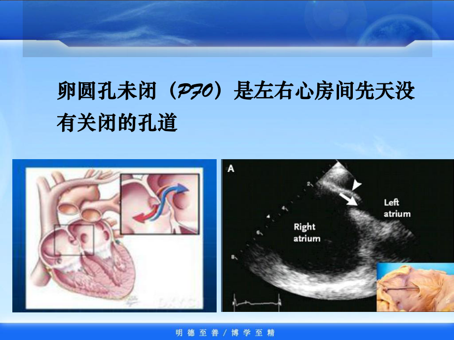 张明宇卵圆孔未闭封堵治疗课件.ppt_第2页