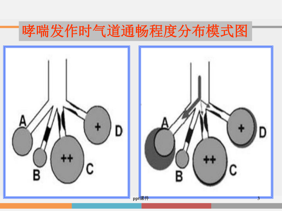 危重症哮喘急性发作的机械通气治疗-课件.ppt_第3页