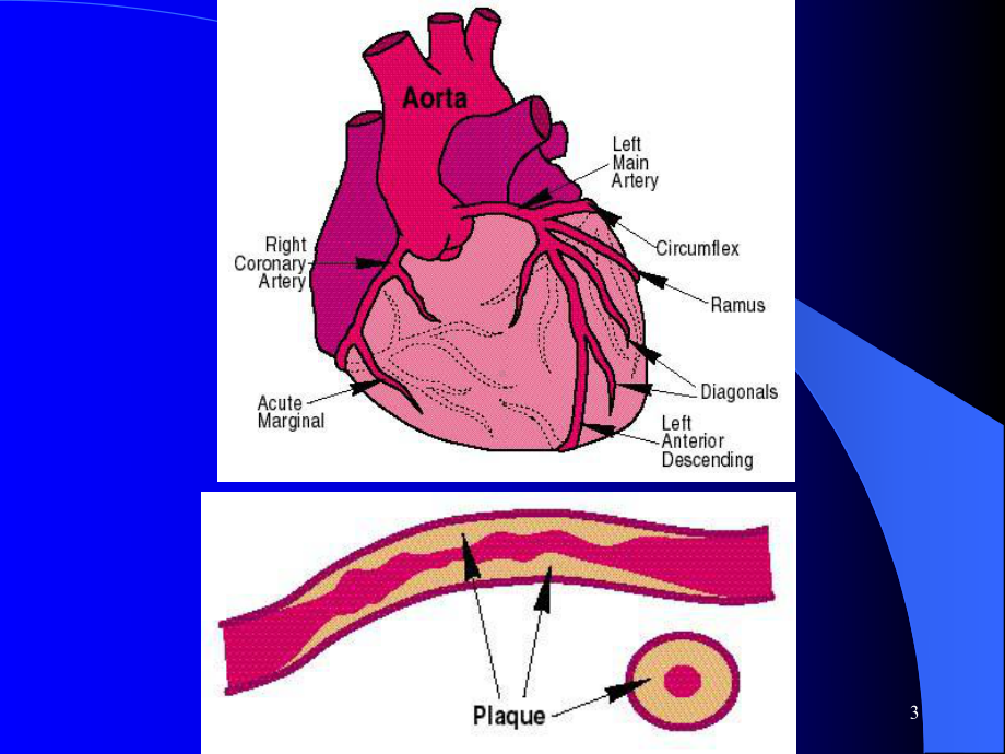 冠状动脉介入治疗进展课件.ppt_第3页