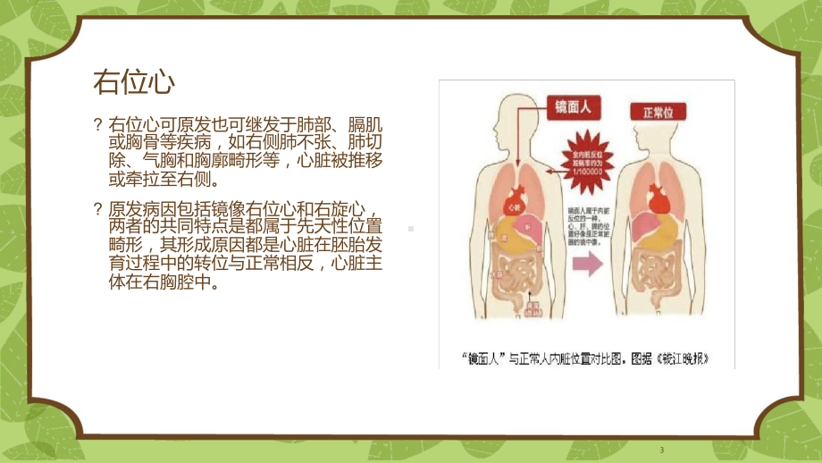 右位心的心电图表现课件.ppt_第3页