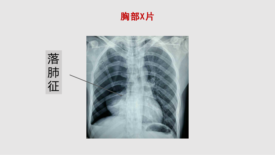 创伤性支气管断裂课件.pptx_第3页