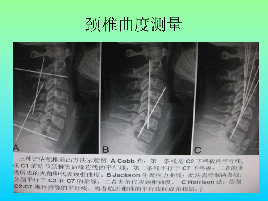 常用脊柱测量方法及其临床意义医学课件.ppt_第2页