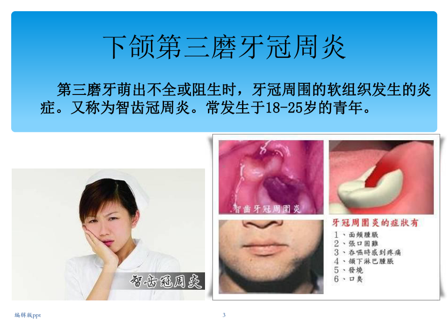 常见口腔科疾病课件.ppt_第3页