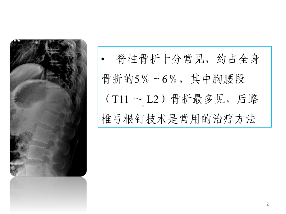 后路椎弓根螺钉治疗胸腰椎骨折课件.ppt_第2页