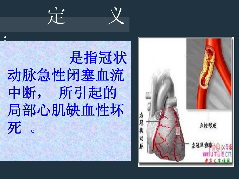 急性心肌梗死抢救护理教学讲义课件.ppt_第3页