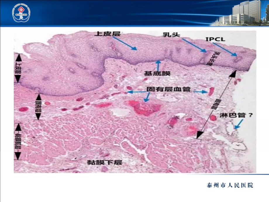 早期食管黏膜病变病理学形态课件.ppt_第3页