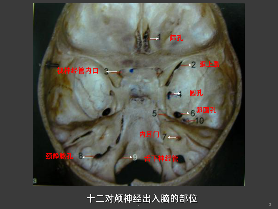 斜坡肿瘤MRI诊断课件.ppt_第3页