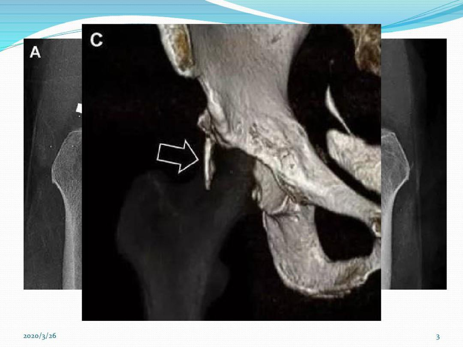 放射科医生千万不要漏诊的36种骨折参考课件79张课件.ppt_第3页