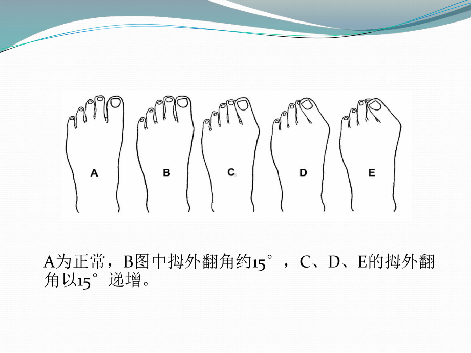 拇外翻的诊断治疗-课件.ppt_第3页