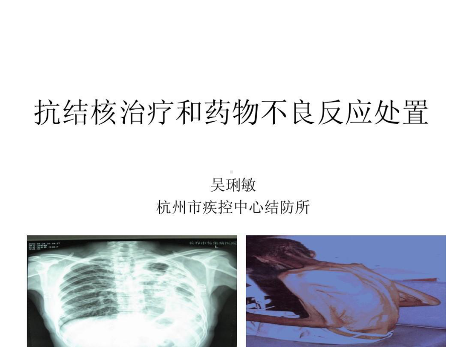 抗结核治疗和药物不良反应处置共90张课件.ppt_第1页