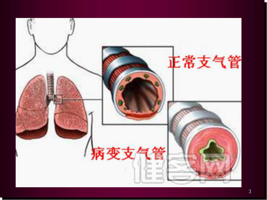 支气管扩张症护理查房医学课件.ppt_第3页