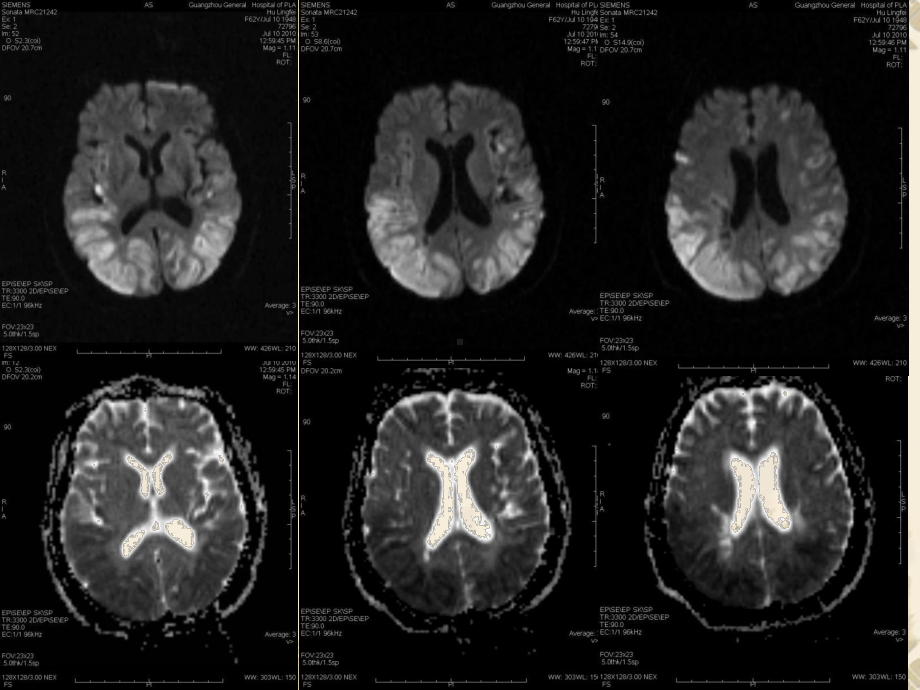 总结DWI在颅脑疾病诊断中的应用-(中)课件.ppt_第2页