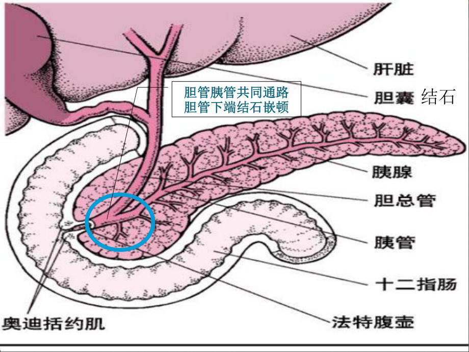 急性重症胰腺炎课件.ppt_第2页