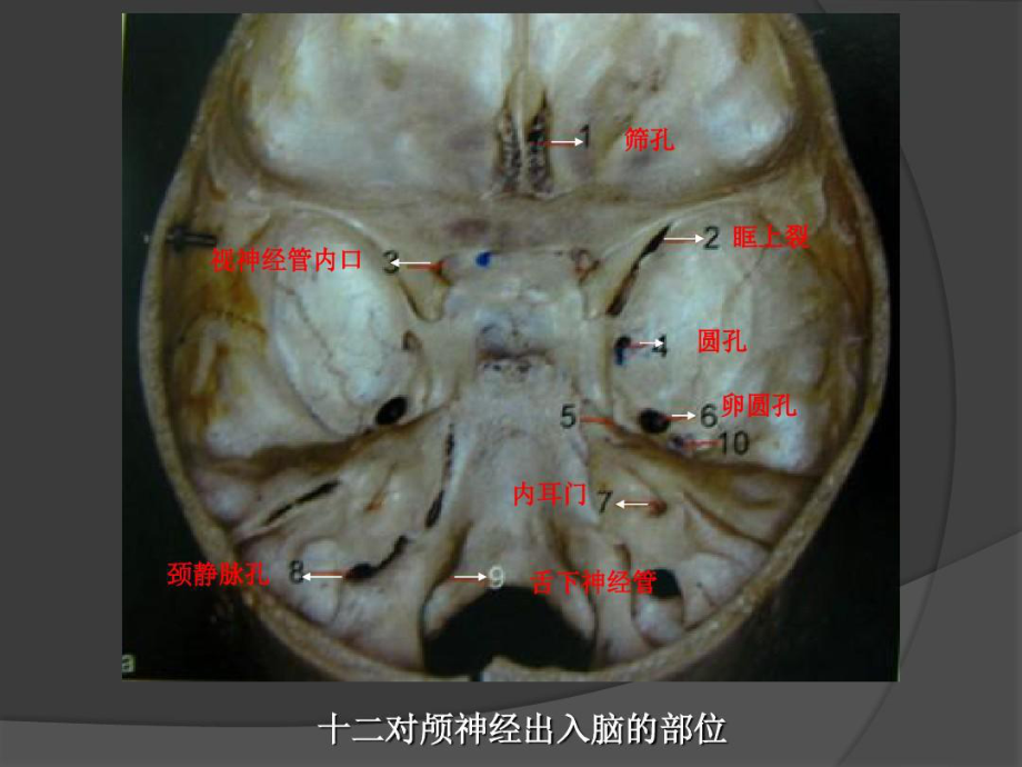 斜坡肿瘤MRI诊断34张课件.ppt_第3页