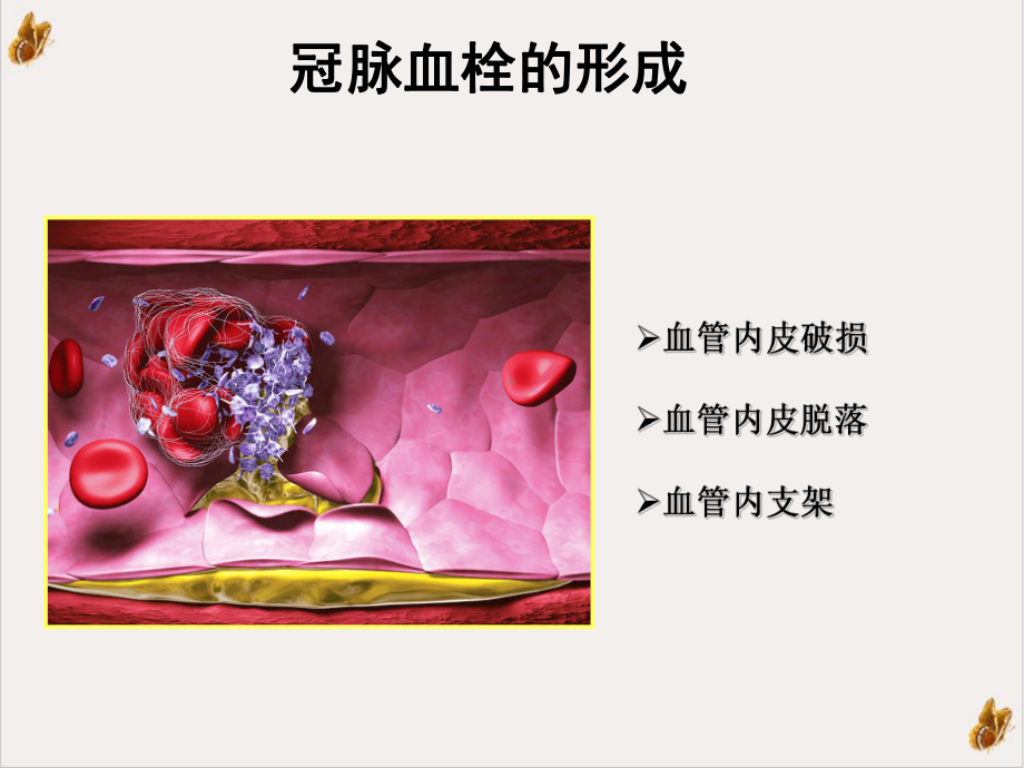 抗血小板药物培训课件.ppt_第3页