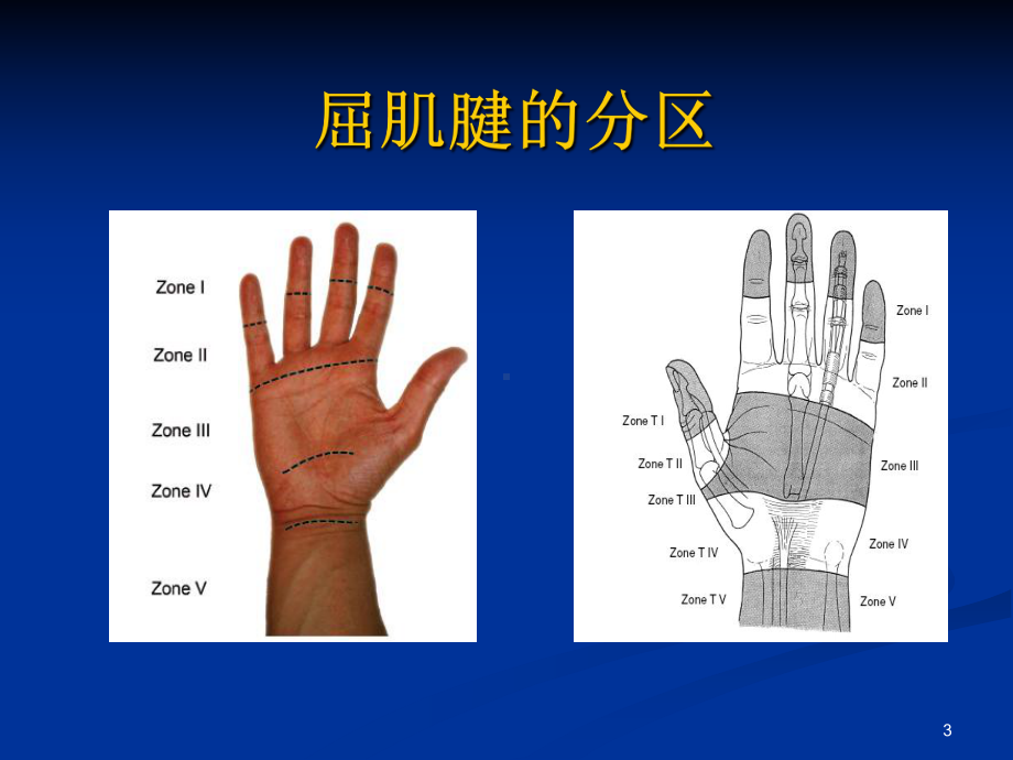 手部肌腱损伤与修复课件.ppt_第3页