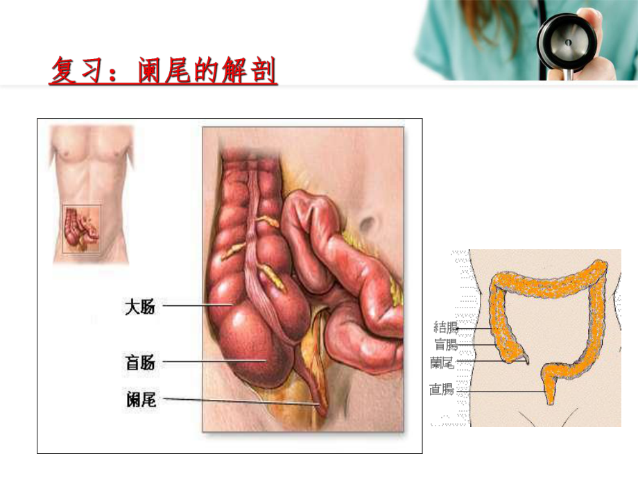 急慢性阑尾炎的治疗与护理课件.ppt_第3页