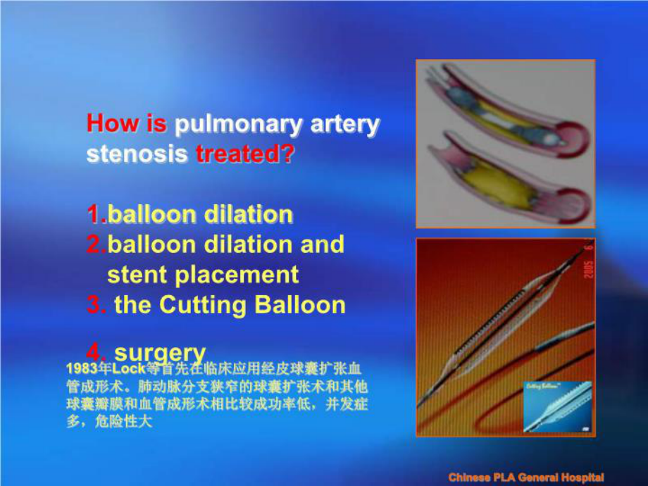 肺动脉狭窄球囊扩张及支架植入病例报告课件.ppt_第3页