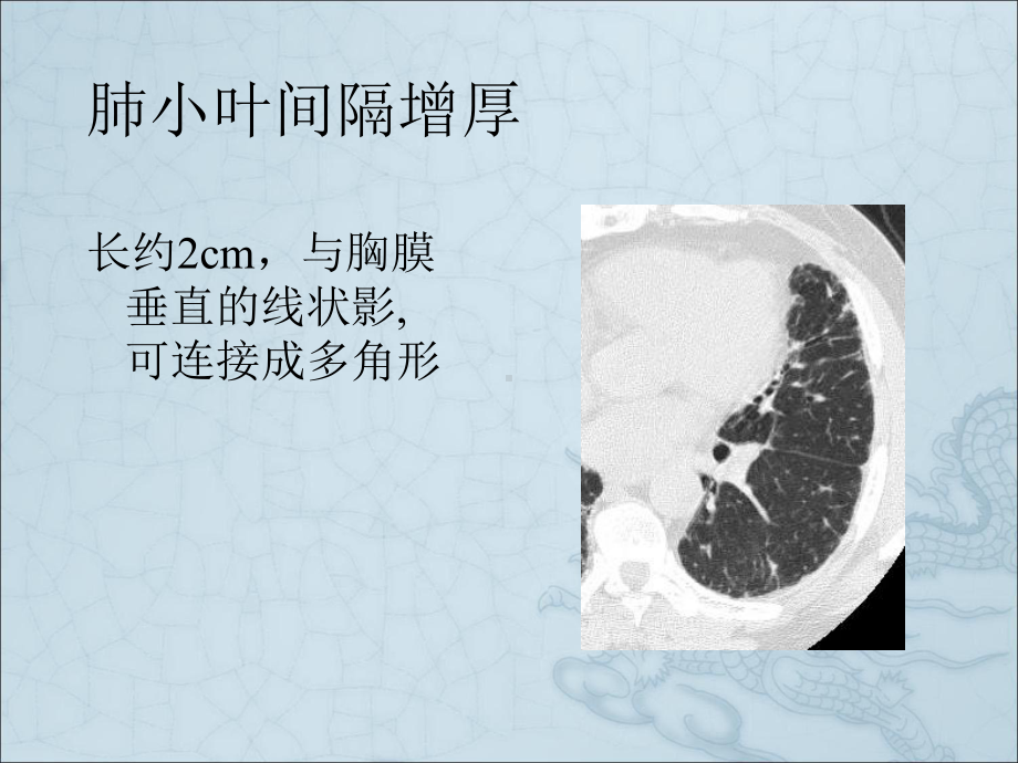 间质性肺疾病的诊断课件.pptx_第3页