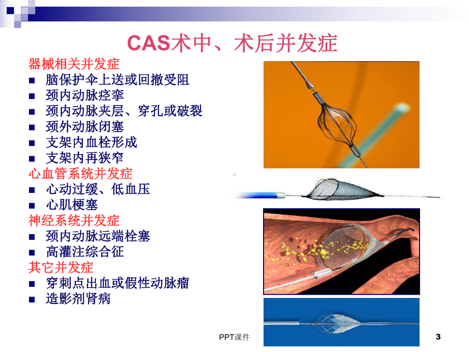 颈动脉支架研究及常见并发症-课件.ppt_第3页