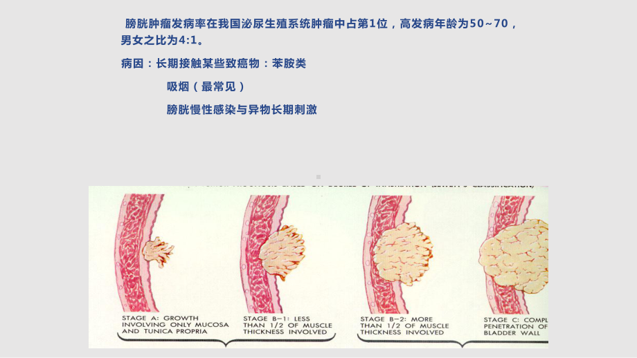 泌尿1一例膀胱肿瘤患者护理查房学习课件.pptx_第3页