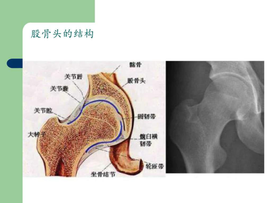 股骨头坏死诊治原则--课件.ppt_第3页