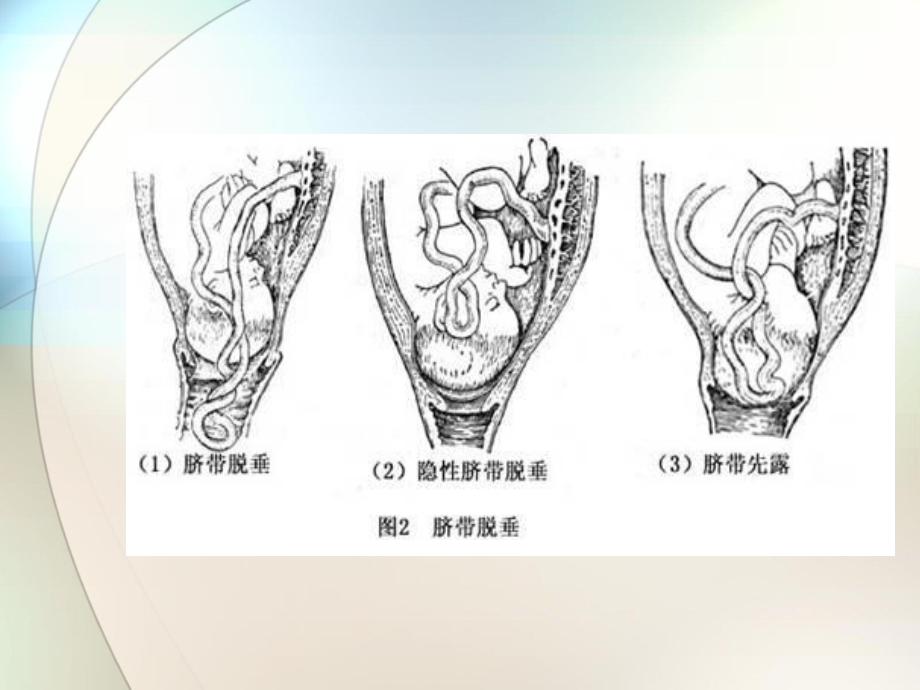 脐带脱垂参考课件.ppt_第3页