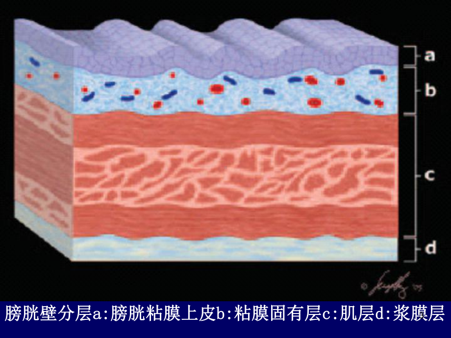 膀胱肿瘤影像诊断医学课件.ppt_第3页