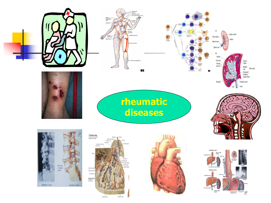 风湿性疾病概论课件.ppt_第3页