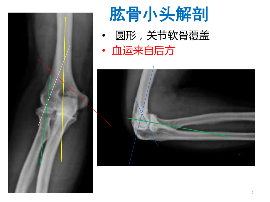 肱骨小头骨折的手术技巧课件.pptx_第2页