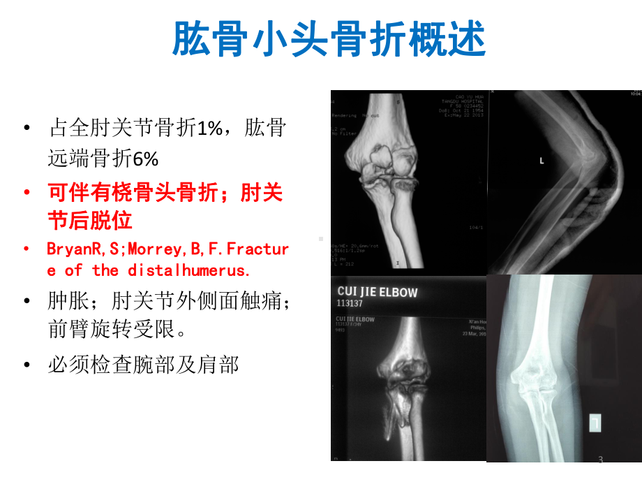 肱骨小头骨折的手术技巧课件.pptx_第3页