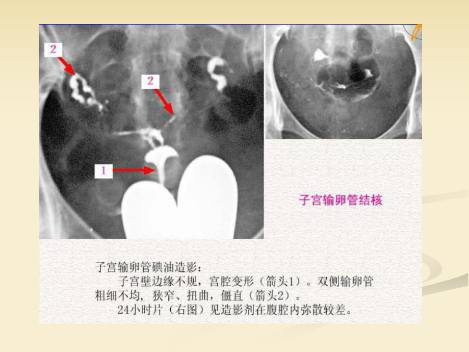 生殖系统炎症肿瘤影像表现课件.ppt_第3页