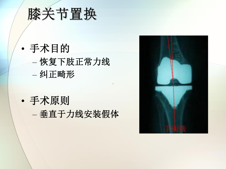 膝关节手术操作参考课件.ppt_第2页