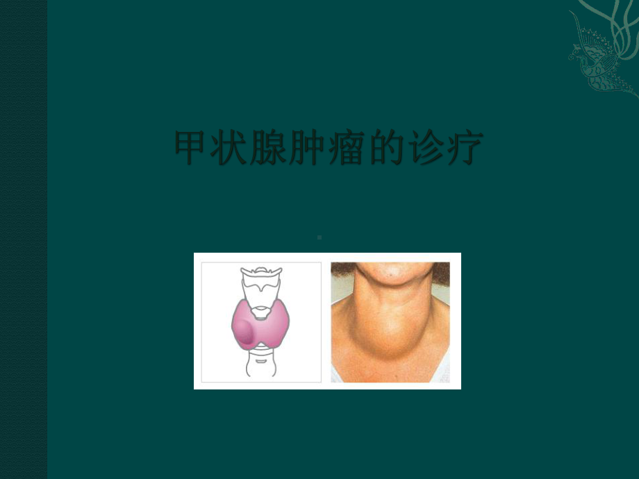 甲状腺肿瘤课件.ppt_第1页