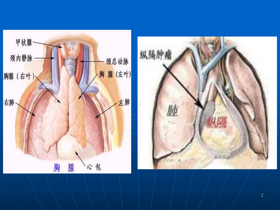 胸腺瘤教育查房课件.ppt_第2页