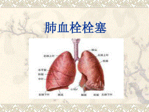 肺栓塞(讲课教学课件).ppt