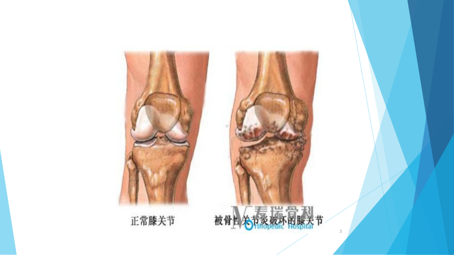 膝关节骨性关节炎的护理课件.ppt_第3页