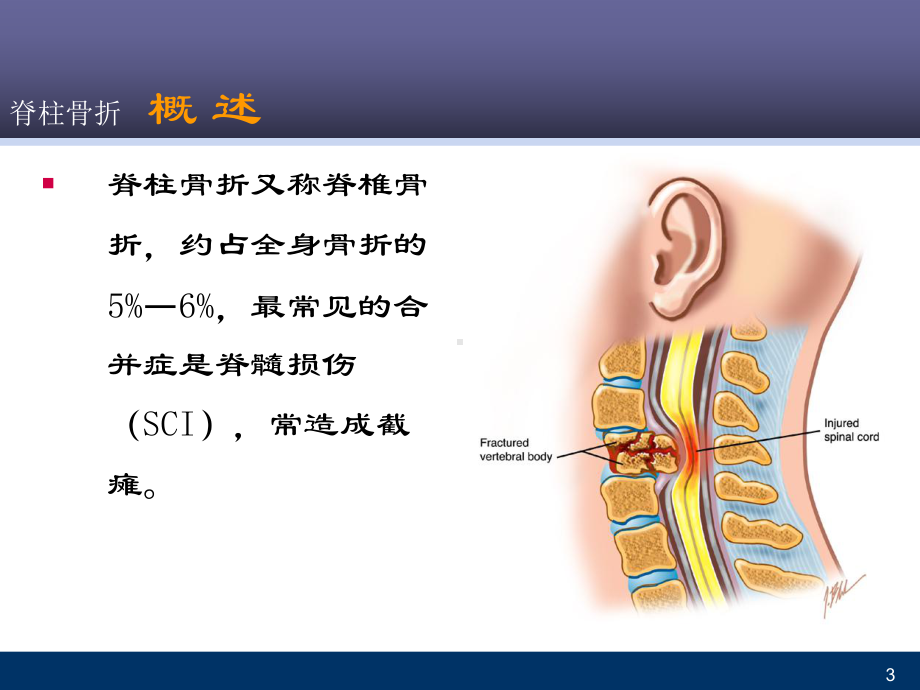 脊柱骨折-课件.ppt_第3页