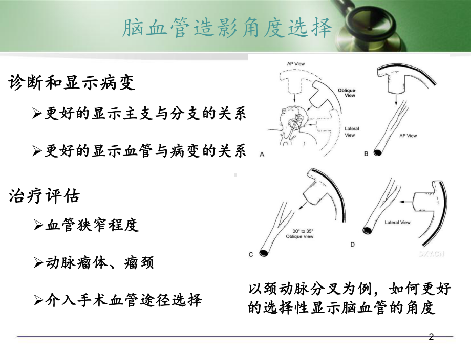 脑血管造影角度选择课件.ppt_第2页