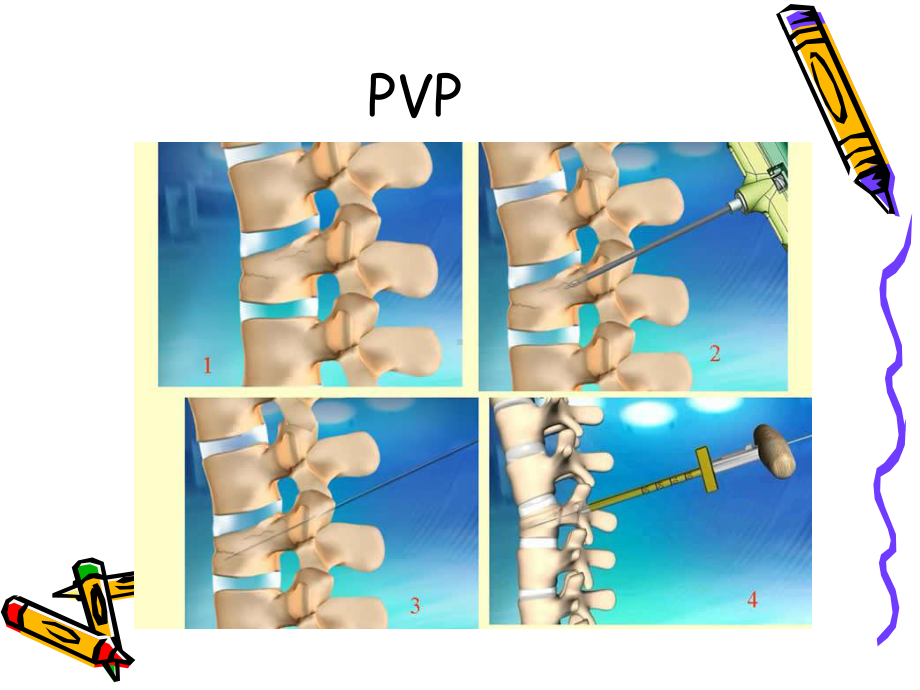 椎体成形术手术步骤课件.ppt_第3页