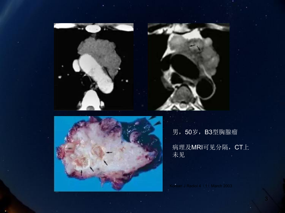 胸腺肿瘤影像诊断教学课件.ppt_第3页