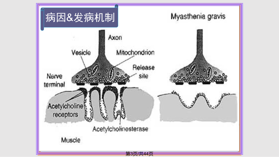 重症肌无力-课件.pptx_第3页