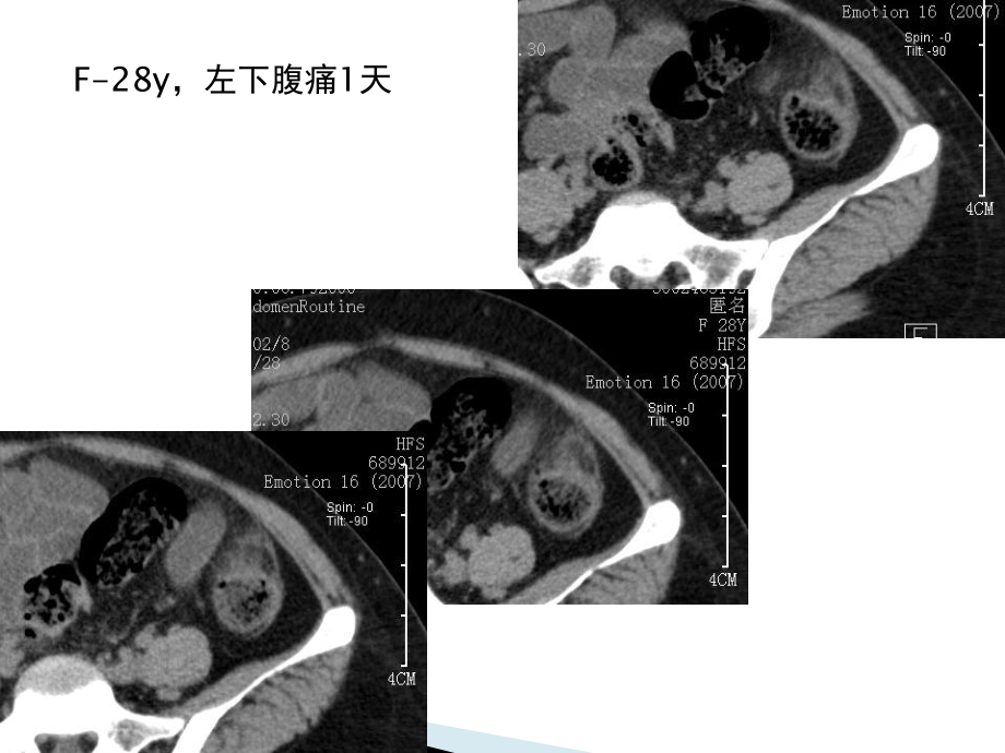 腹腔炎性脂肪性肿块和鉴别诊断课件.ppt_第1页