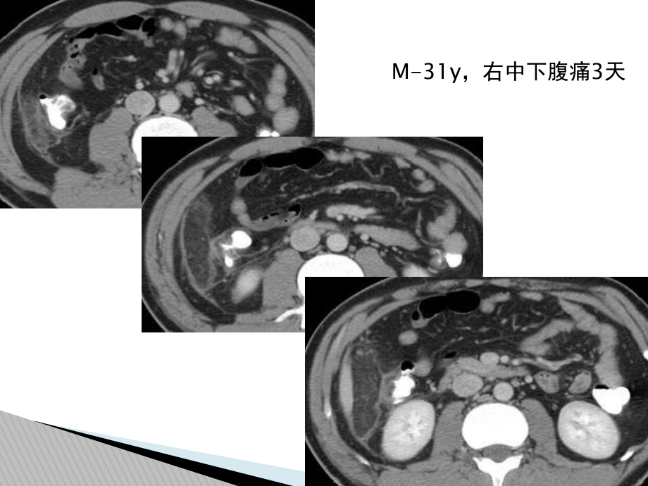 腹腔炎性脂肪性肿块和鉴别诊断课件.ppt_第2页